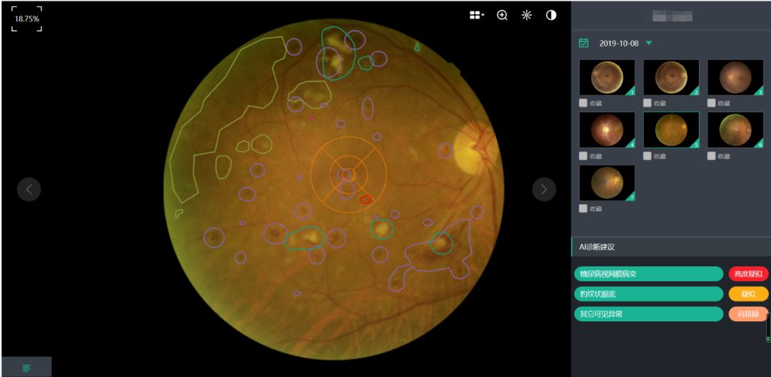 何氏眼科：公司“光明小屋”以眼科智能设备为入口，结合线上和线下的眼科诊疗系统，通过先进的 AI 智能诊断，发现眼部疾病和慢性疾病